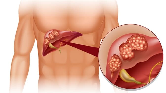 Liver Cancer: Understanding Symptoms, Causes, and Treatment Options